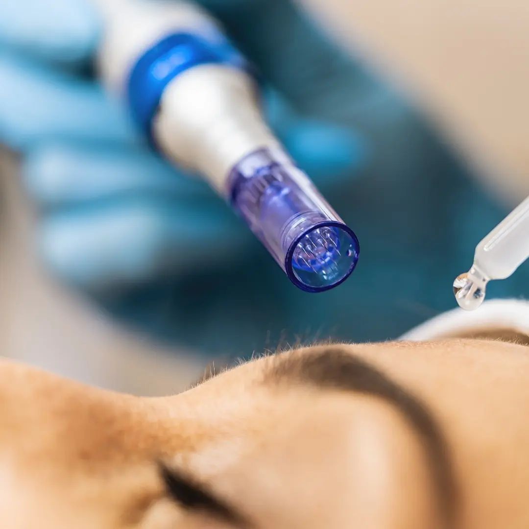 Facial Microneedling